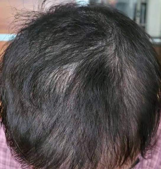 “我控制不住啊！”14岁漂亮女孩硬生生把自己拔成秃顶，真相令人唏嘘