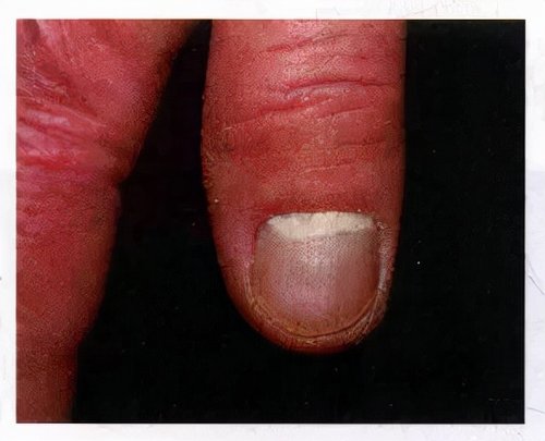 脚指甲变厚有竖纹是怎么回事,脚趾甲变黄变厚有竖纹是咋回事