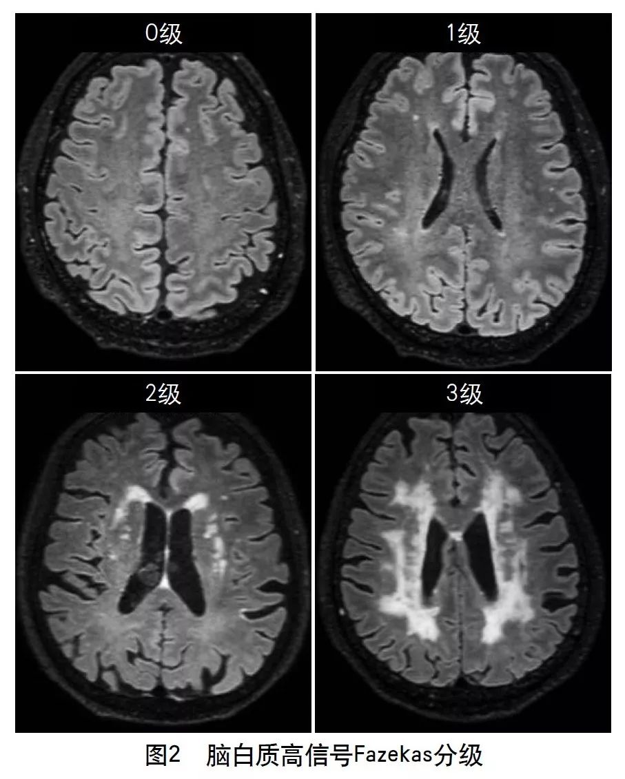 脑血管病影像诊断大全汇总,脑小血管病变影像学表现
