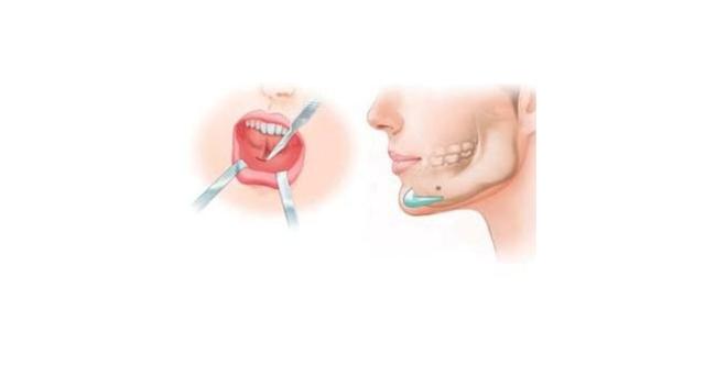 尖下巴女人的脸型,最新的隆下巴方式