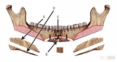 那些削骨的女明星怎么样了,哪些明星承认削骨了