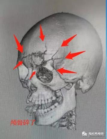 意外伤害很严重年纪轻轻难保命，谭院刀刀用真情豫南名医中中中