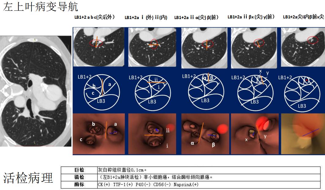 小细胞肺癌的气管镜介入治疗,导航支气管镜在肺癌诊断中的应用