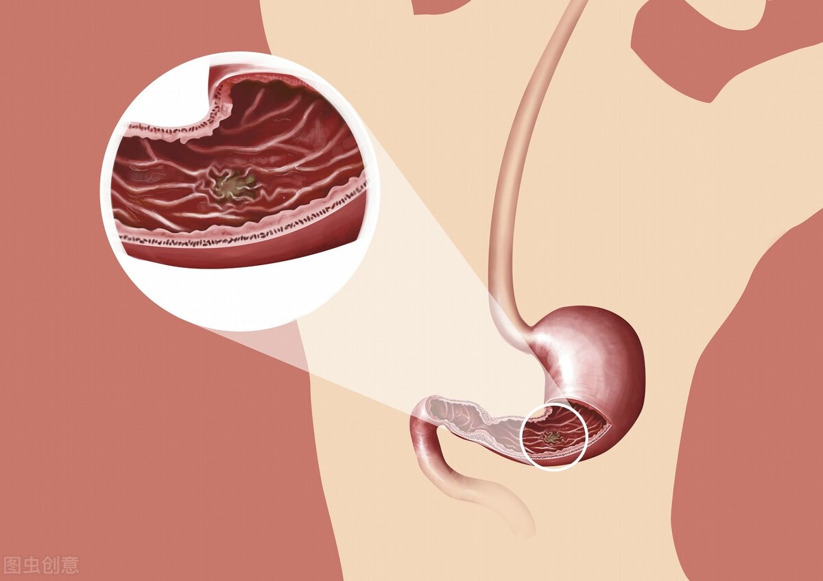 疏肝解郁和胃的中药方子,疏肝理气和胃止痛的方子