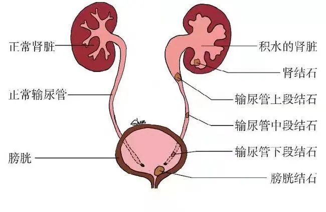 小结石有可能引起潜血吗,小结石引起的肾积水要紧吗