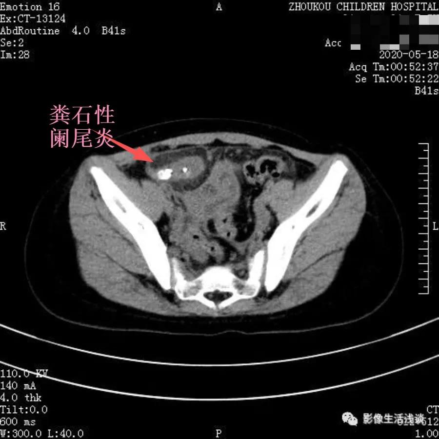小朋友腹痛呕吐无其他症状,孩子有腹痛呕吐症状家长切莫大意