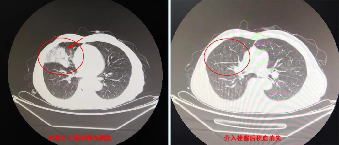 病人突然大咯血需要介入吗,医生抢救肺栓塞视频
