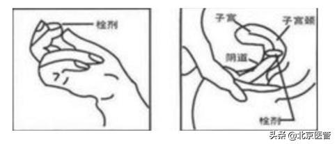 霉菌性阴道炎反反复复？药师教您正确用药，摆脱难言之隐