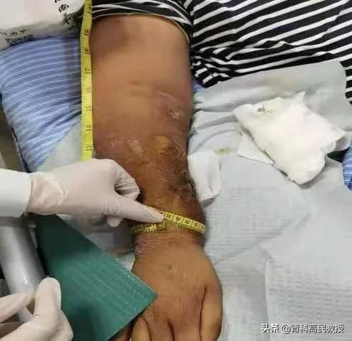 尿毒症手臂造瘘,乳腺癌十年胳膊肿了会有危险吗