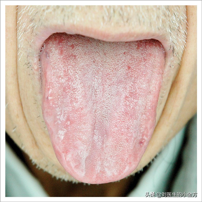 舌象图解大全中医舌诊,最全中医舌诊图谱来了