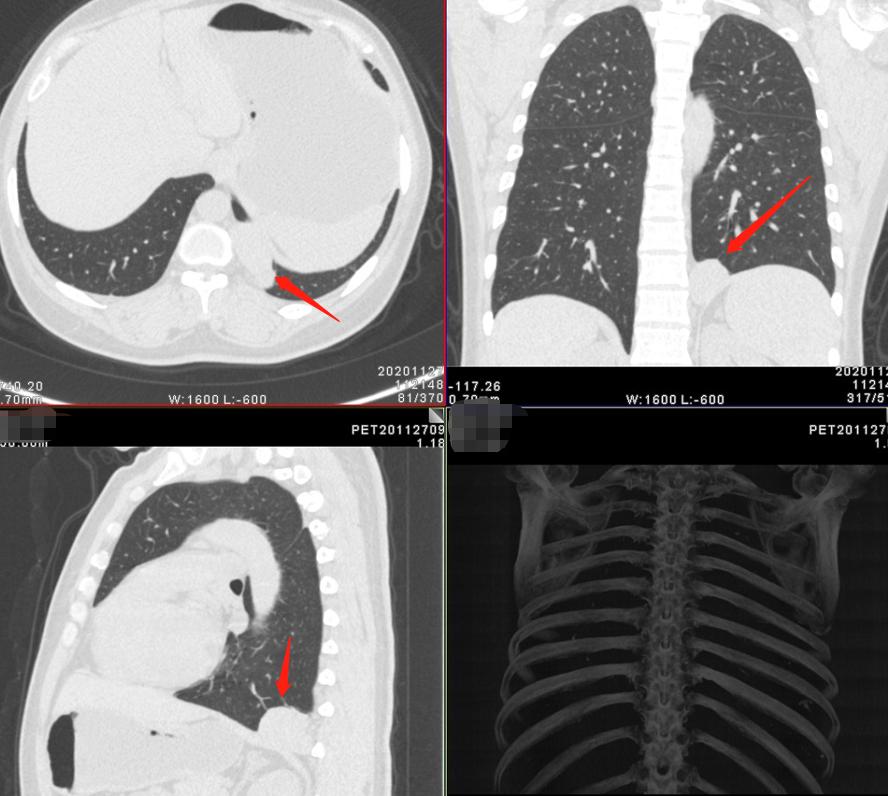 9mm肺结节实性结节良性几率多大,良性肺结节生长速度