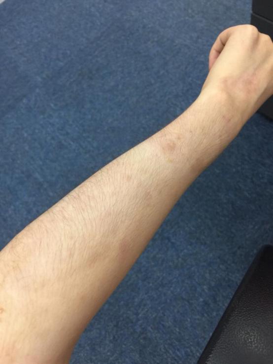 有体毛的女生要脱毛吗,体毛少可以不刮毛直接冰点脱毛吗