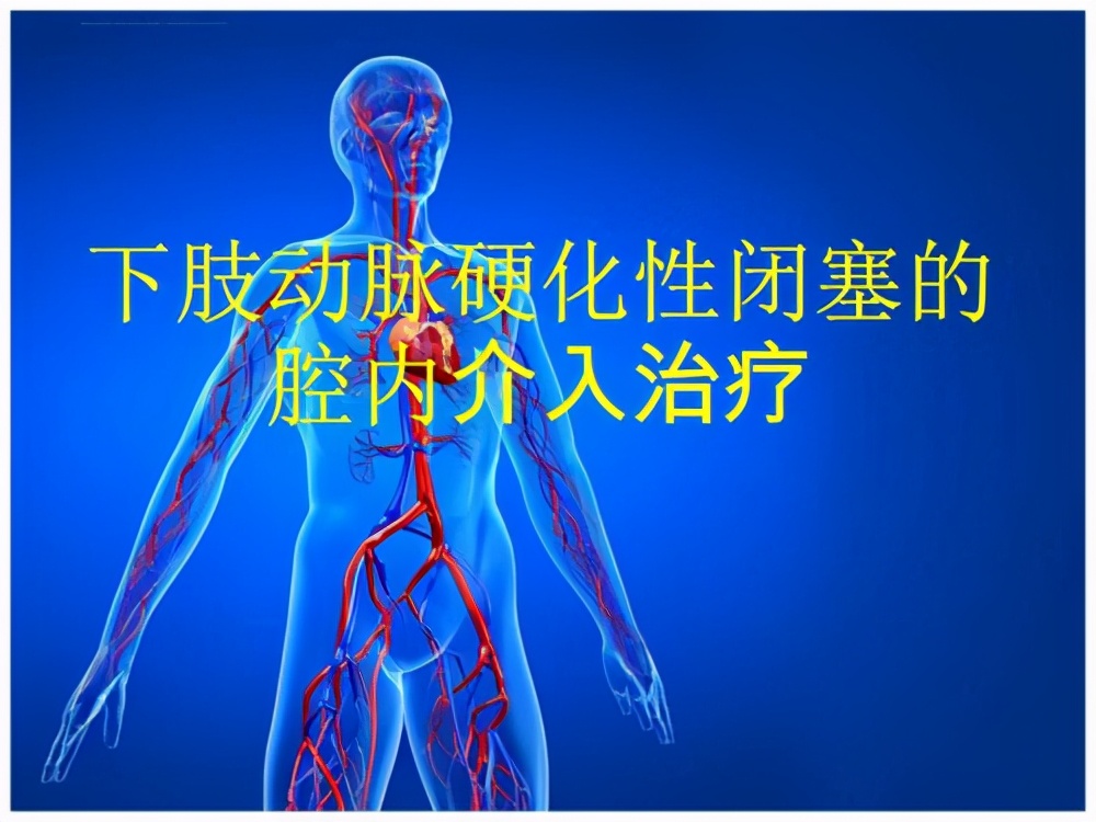 动脉硬化性闭塞症好发人群,动脉硬化性闭塞症是什么原因造成