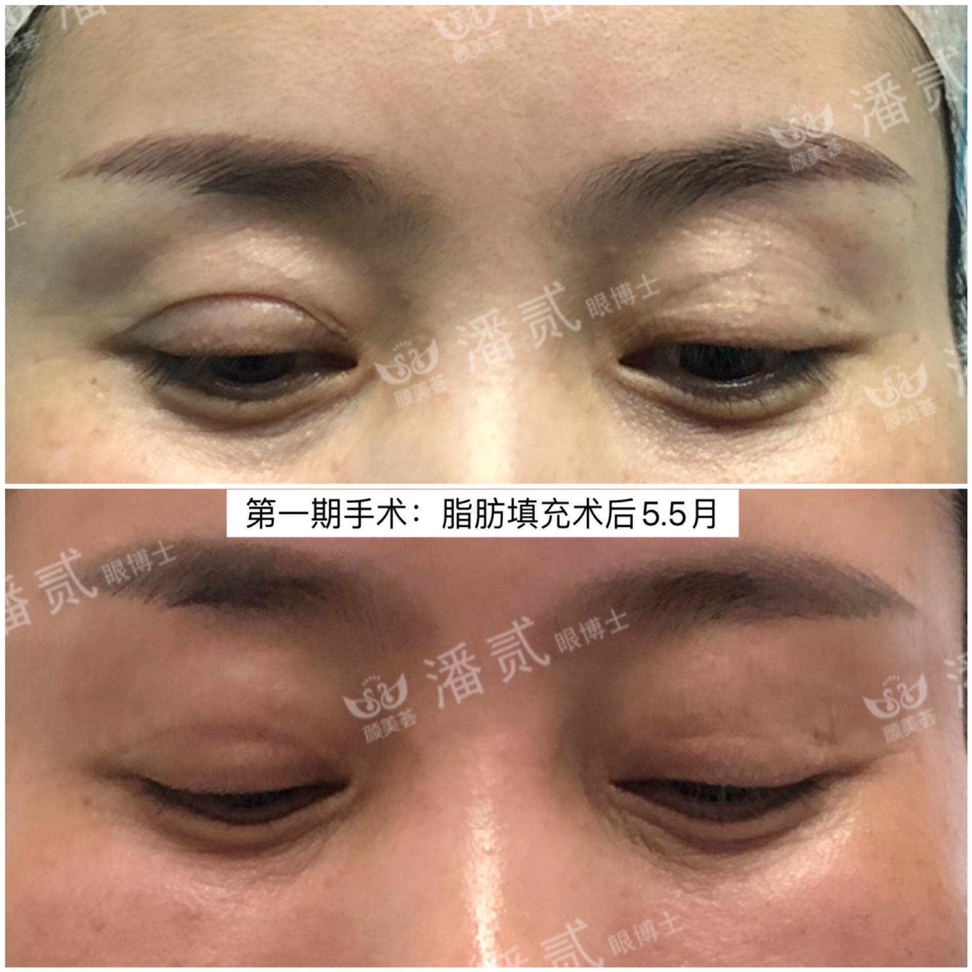 做双眼皮手术后眉毛会变吗,做双眼皮手术的疤痕会消失吗