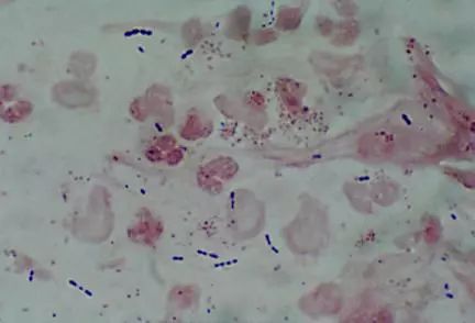 肺炎炎症图片,肺炎病历单图片