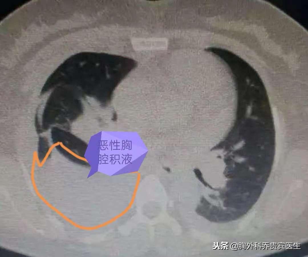 胸膜间皮瘤靶向治疗药,中医治疗胸膜间皮瘤