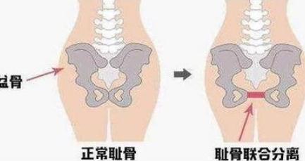 孕妈最痛苦的事,每个孕妇都必须会经历耻骨疼吗