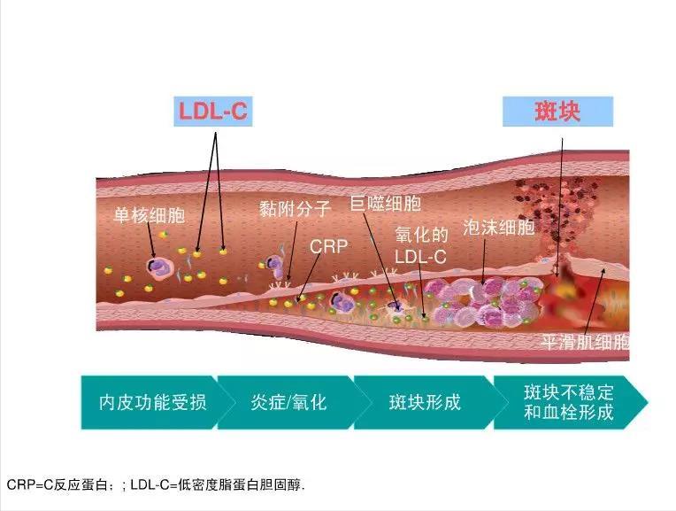 动脉斑块多长时间可以逆转消失,心脏动脉斑块可以消除吗