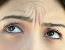 肉毒素打鱼尾纹范围大注射点图解,鱼尾纹肉毒素的危害和后遗症