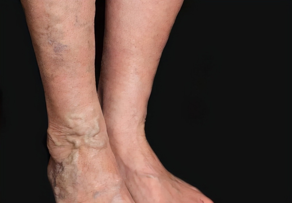 青筋容易暴起是什么原因,青筋暴起的原因有哪些