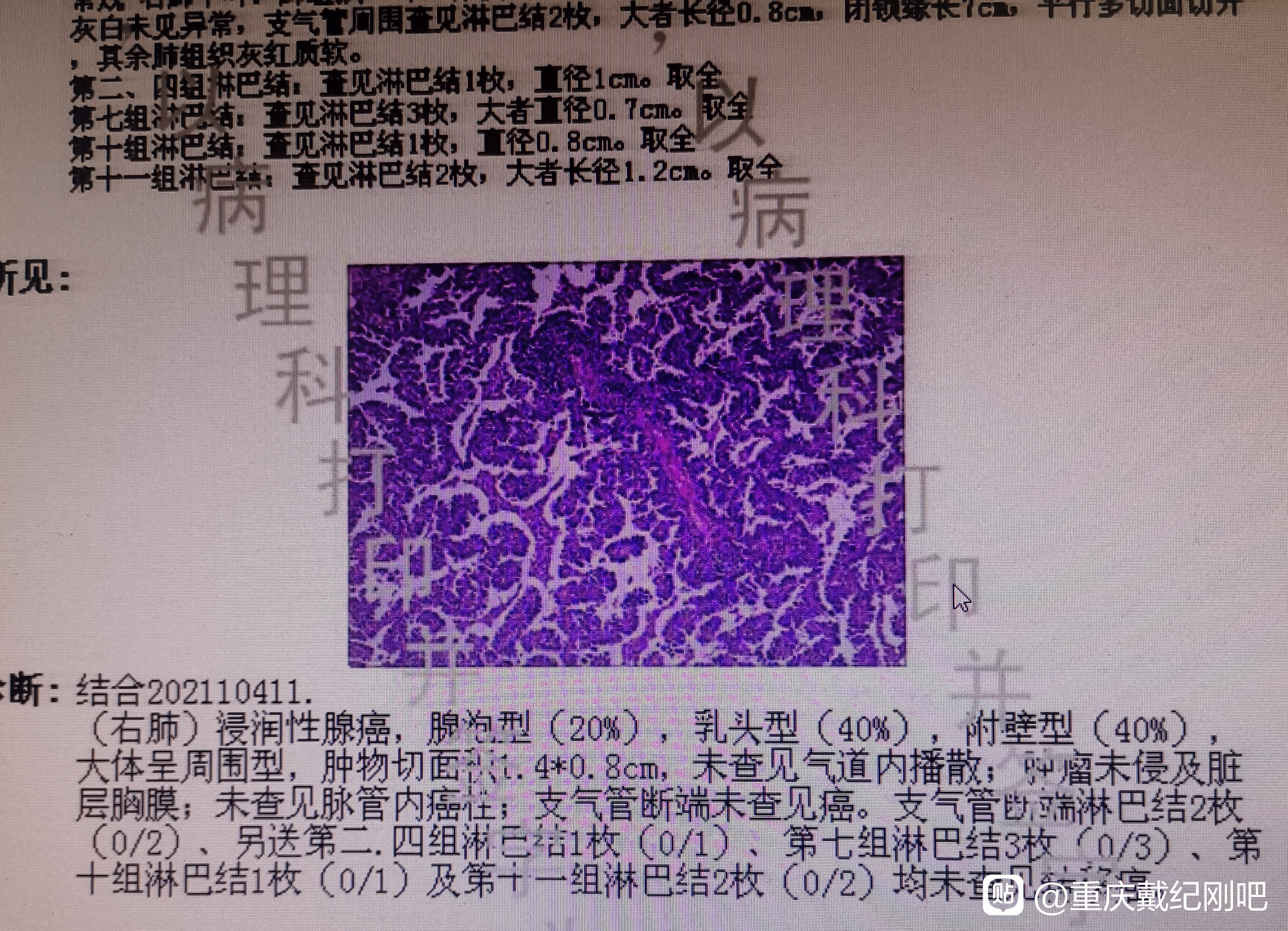 肺癌真的100%无法治愈吗？医学上没有绝对，想再多也只是徒增烦恼