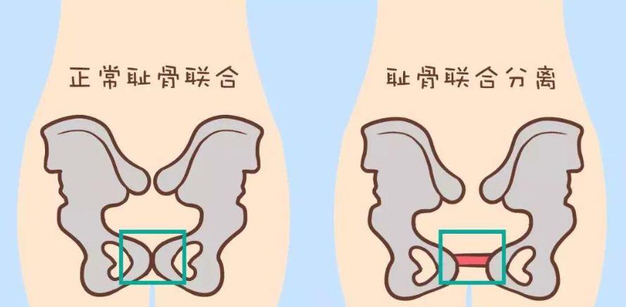 月子里干活落下的腰腿痛能治好吗,产后得腰腿疼痛还能治好吗