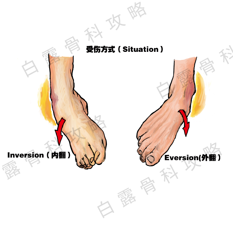 崴脚后48小时紧急处理,崴到脚紧急处理