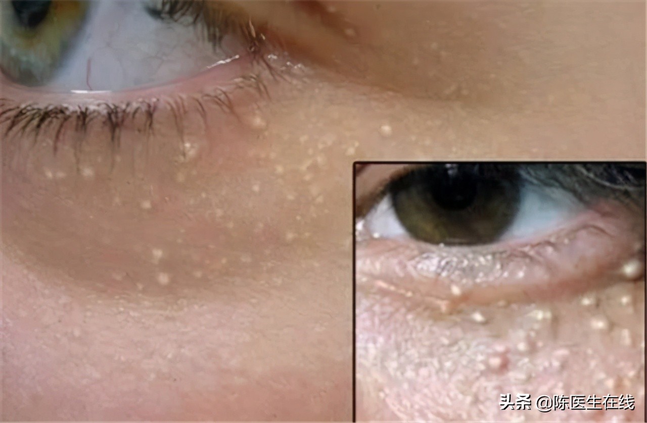 眼周脂肪粒去除方法是真的吗,眼下有脂肪粒怎么根除不复发