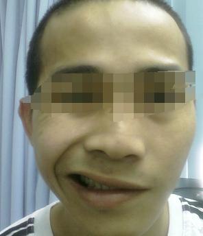 面神经麻痹，嘴巴歪了还能不能好起来？歪嘴巴纠正方法