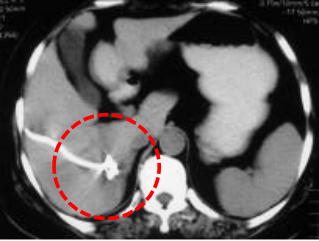 举例科普|介入能治疗哪些疾病?
