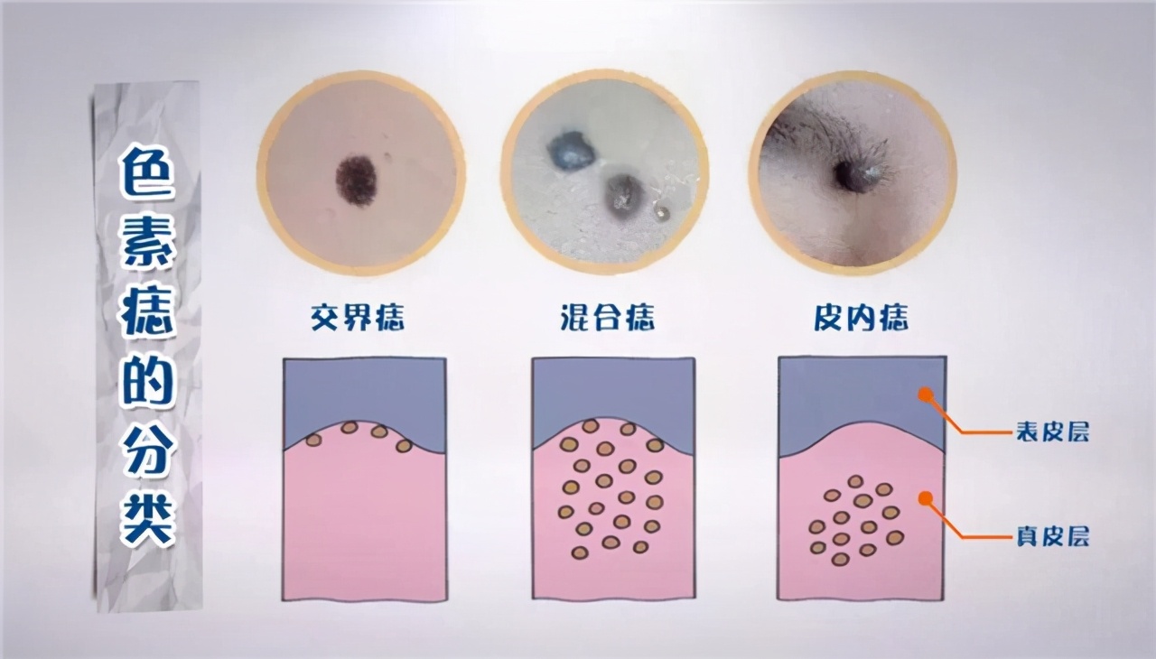 1cm大的黑肉痣是黑色素瘤吗,小孩黑色素瘤和痣的区别