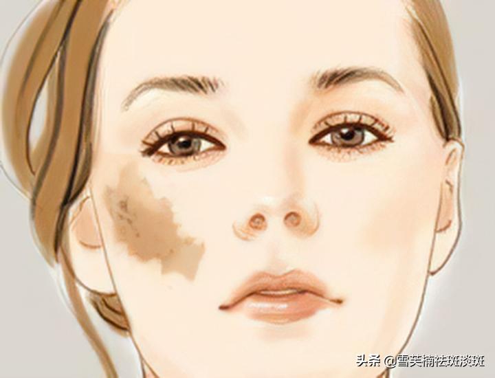 去斑点的最好方法淡斑小妙招,斑点淡斑最好的方法