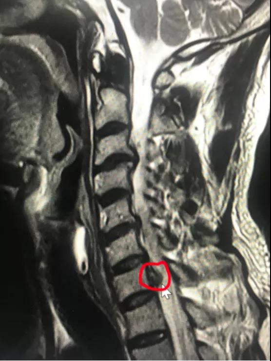 *安泰**市中心医院成功开展颈椎后路内镜“钥匙孔”技术治疗高度游离的颈椎间盘突出症