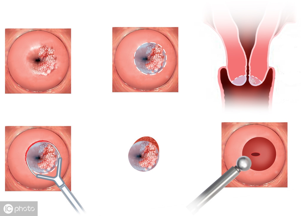 宫颈纳囊是什么东西,宫颈纳囊是什么病