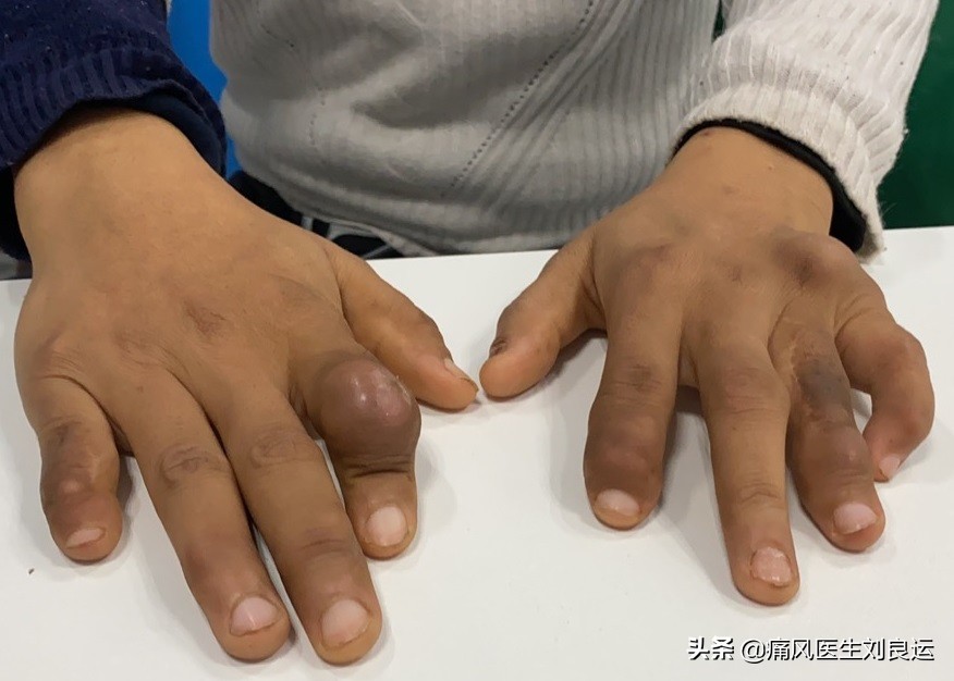 痛风发作怎么避免有痛风石,痛风长石头吗