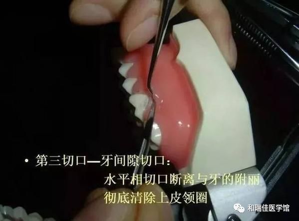 松牙固定需要什么条件,钢丝松牙固定操作流程