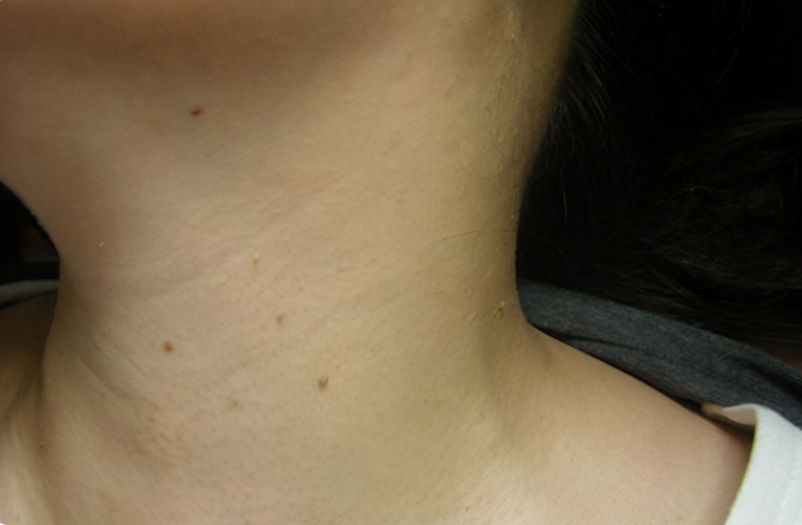 腋下脖子上长小肉粒去除方法,脖子上有小肉粒会传染给其他人吗