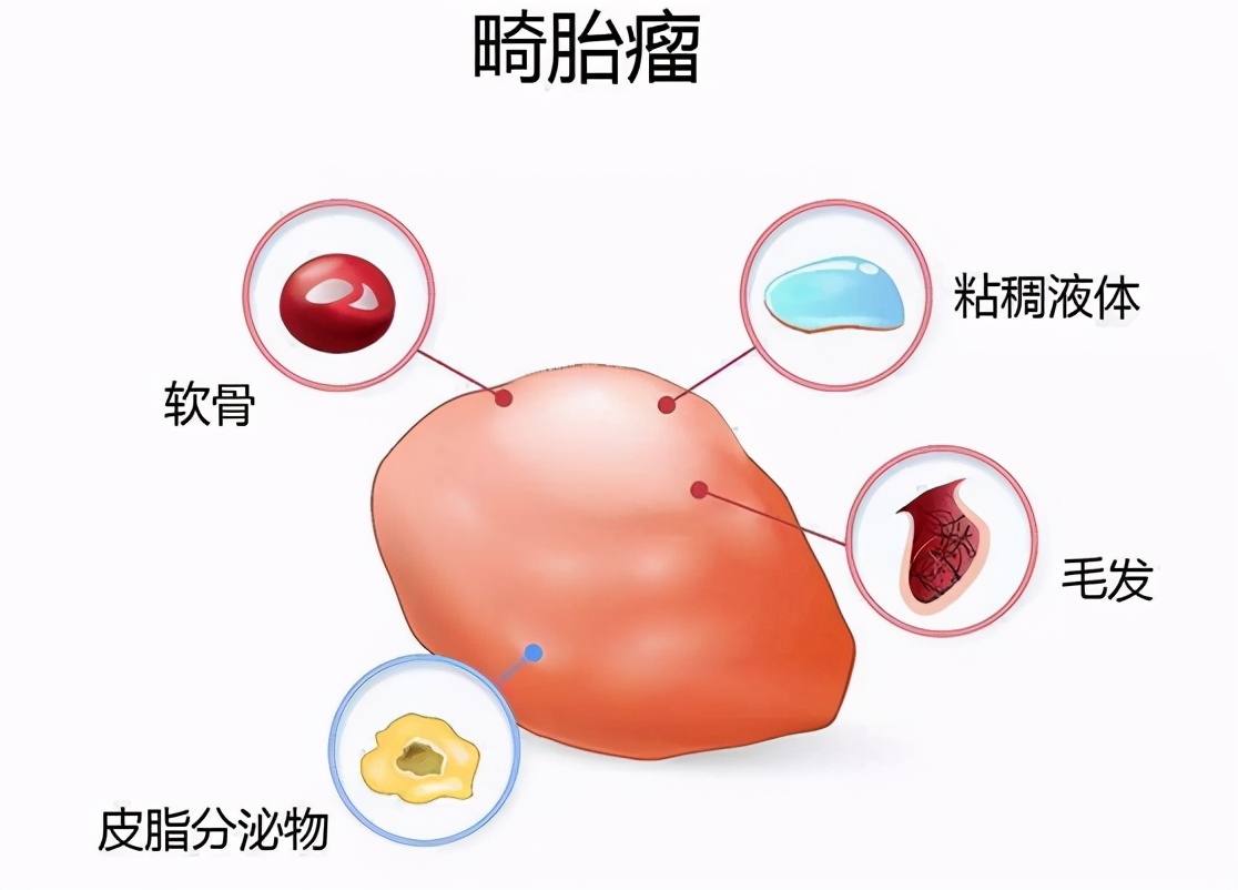 卵巢畸胎瘤是什么,畸胎瘤这个病严重吗