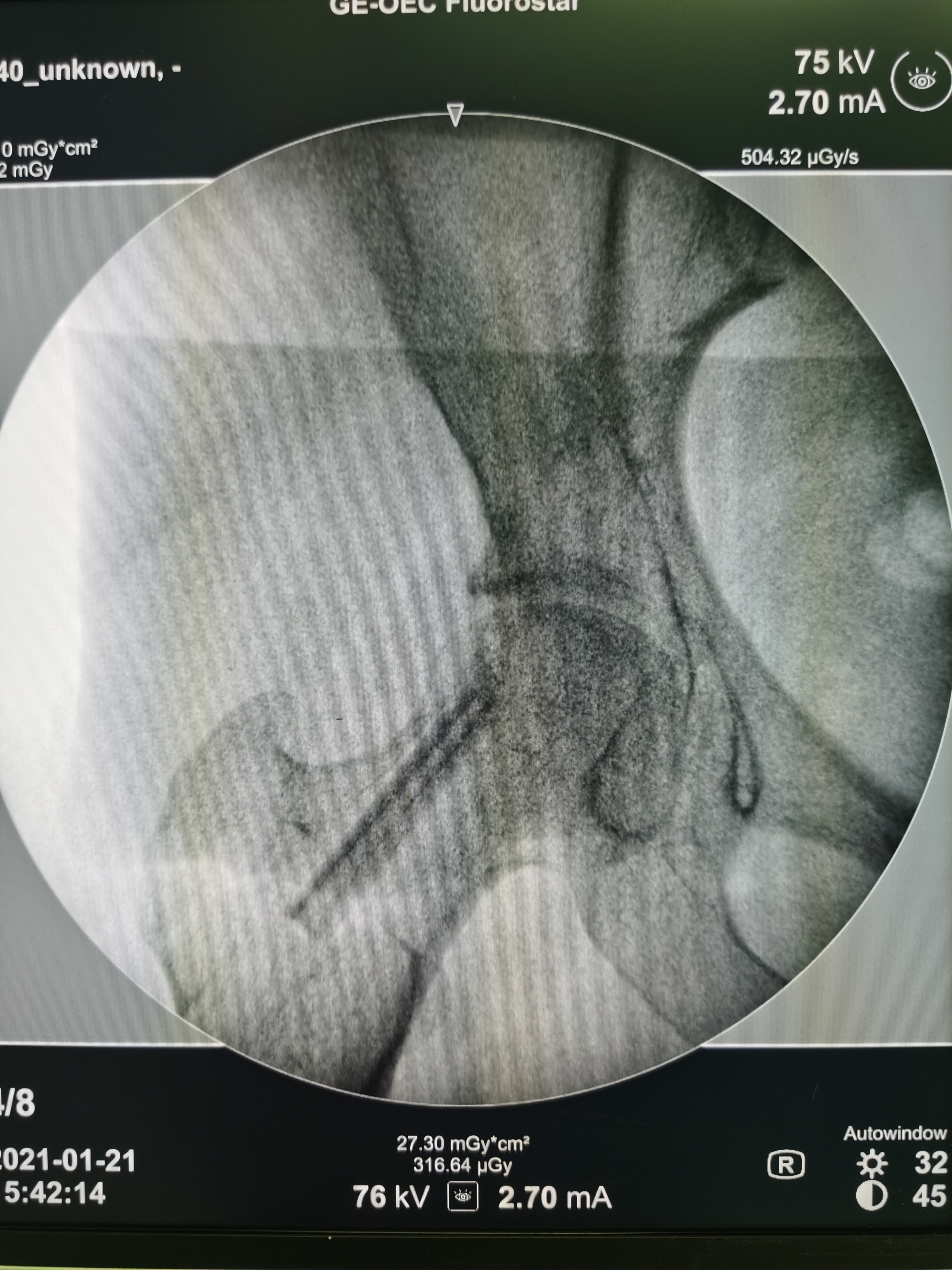 常年用激素股骨头坏死能手术吗,医院用了激素药造成股骨头坏死