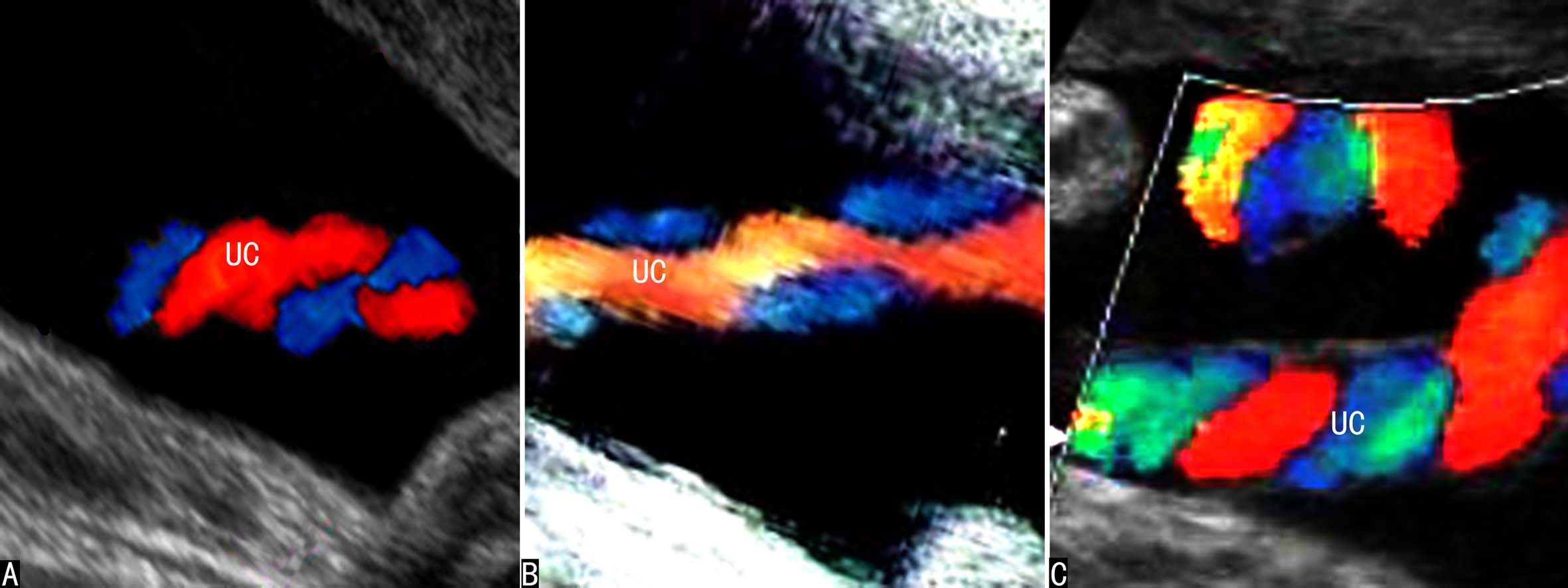 做彩超可以看出来脐带多长吗,超声检查脐带绕颈一圈正常吗