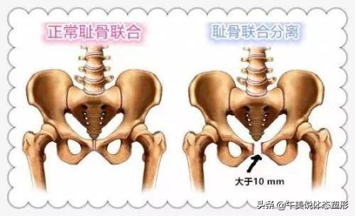 瘦腿瘦臀不翘屁股教程,虐臀圈怎么瘦腿