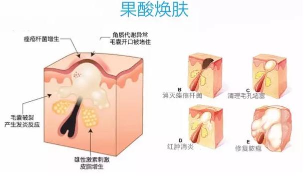 经常使用含酸的护肤品有什么危害,常见含有酸的护肤品有哪些