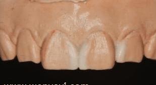 门牙裂了一条缝,门牙有缝的女人