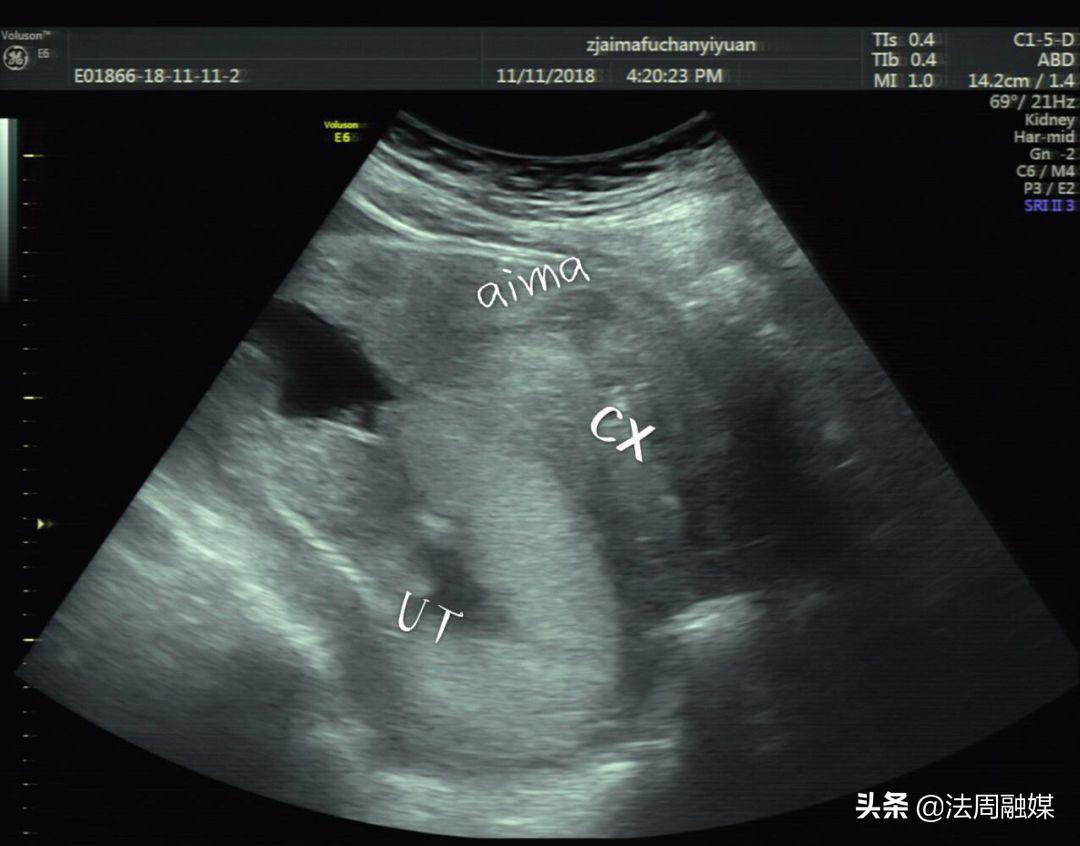 孕妇排尿困难怎么办最快最有效,孕妇小便难解是什么原因