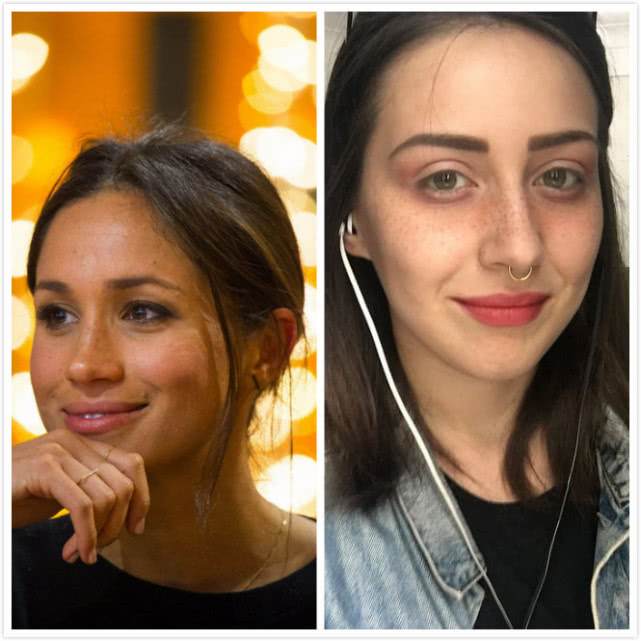 英女子痴迷梅根“雀斑妆”，拙劣手术让面部毁容，花3万治疗修复