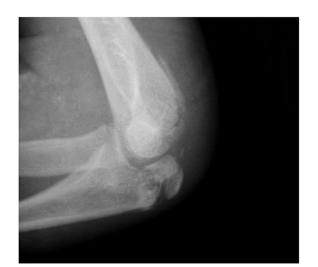 青少年肘部损伤最常见的是,肘部桡神经损伤的临床表现