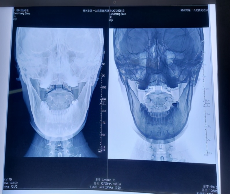 腰骶疼痛最佳治疗方法,腰坐骨神经疼了好多年怎么办