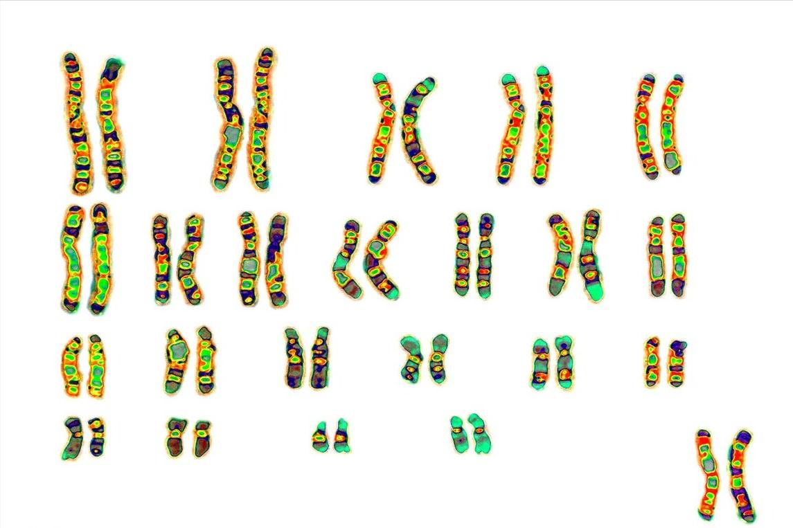 二十一号染色体异常怎么引产,性染色体异常可以引产吗