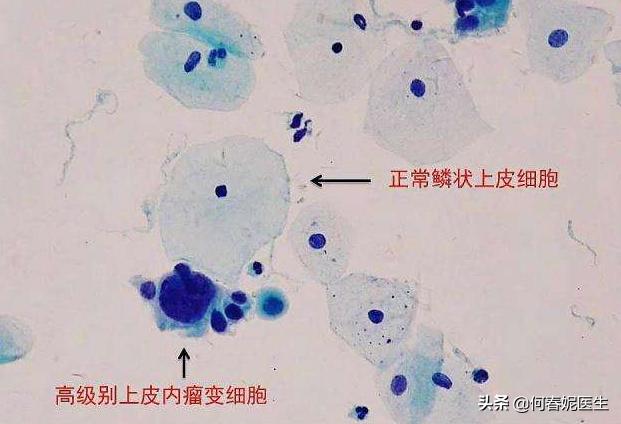 宫颈癌癌前病变无需治疗，一年内可以自动痊愈是真的吗？