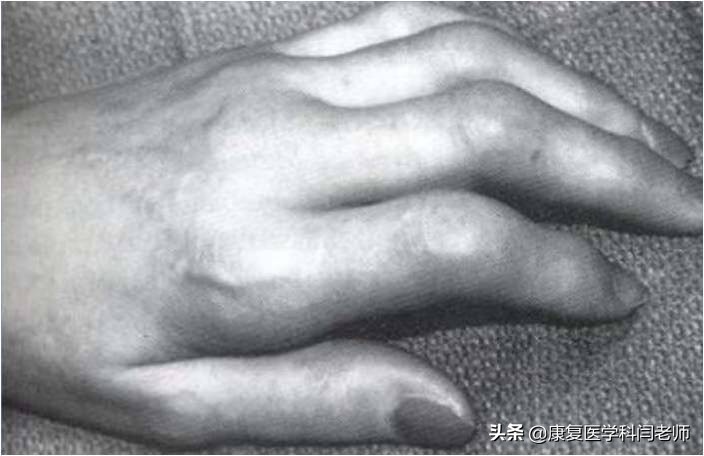 脑卒中后偏瘫患者常见并发症：肩手综合征的康复治疗